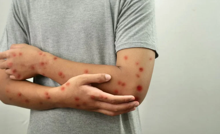 Irecê monitora caso suspeito de Mpox